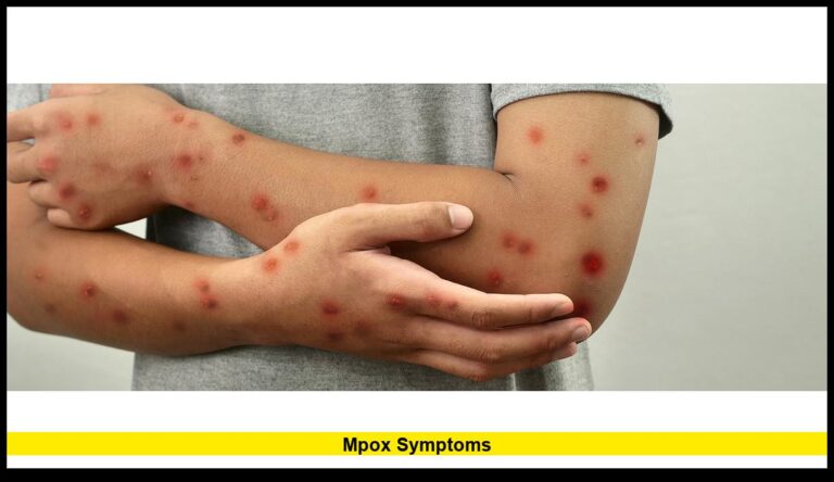 Mpox Symptoms: What to Watch For Amid Rising U.S. Cases